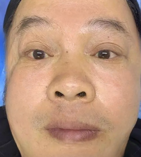 去眼袋手术