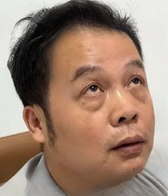 去眼袋手术