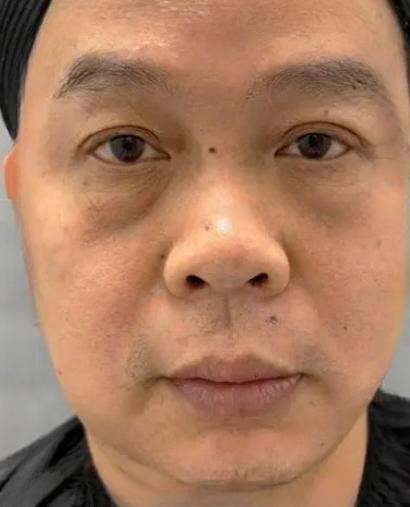 去眼袋手术