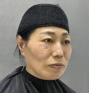 去眼袋手术