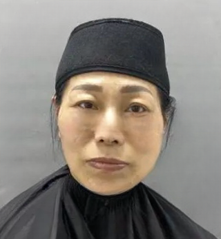 去眼袋手术