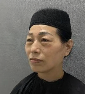 去眼袋手术