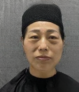 去眼袋手术
