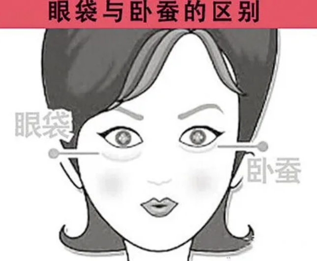 去眼袋手术
