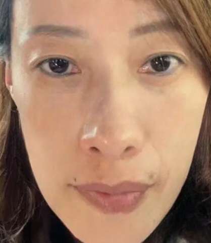 去眼袋手术