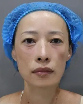 去眼袋手术
