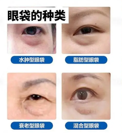 去眼袋手术
