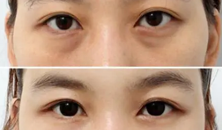 去眼袋手术