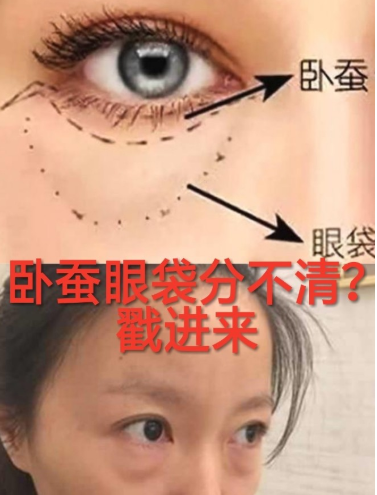 去眼袋手术