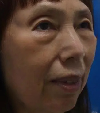 去眼袋手术