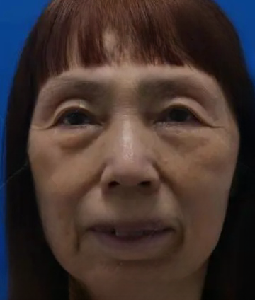 去眼袋手术