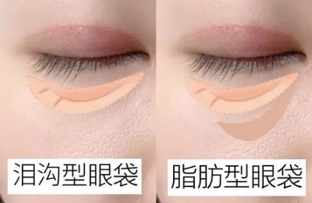 去眼袋手术