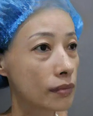 去眼袋手术