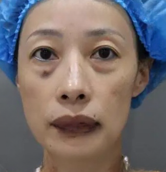 去眼袋手术