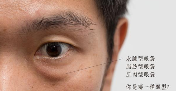 去眼袋手术