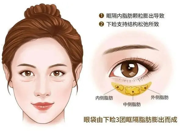 去眼袋手术