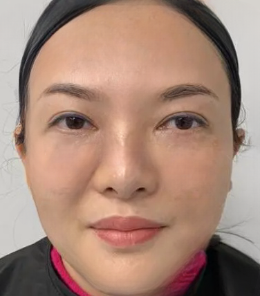 去眼袋手术
