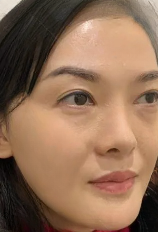 去眼袋手术