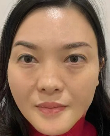 去眼袋手术