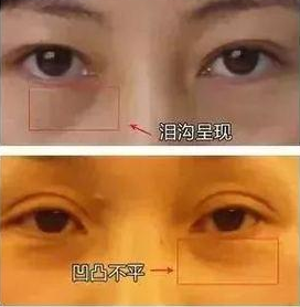 去眼袋手术