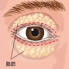 去眼袋手术