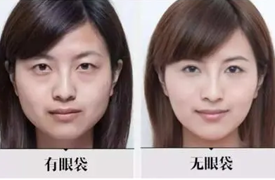 去眼袋手术