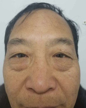 去眼袋手术