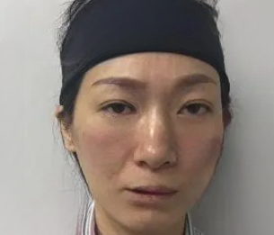 去眼袋手术