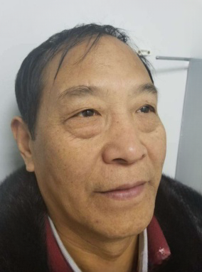 去眼袋手术