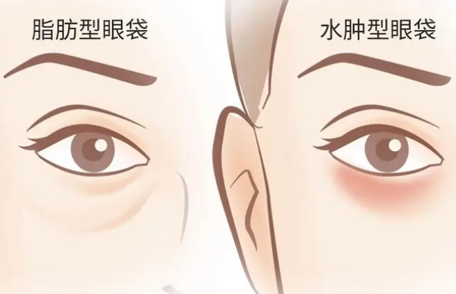 去眼袋手术
