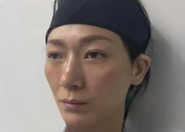 去眼袋手术
