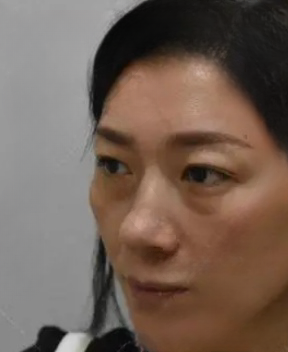 去眼袋手术