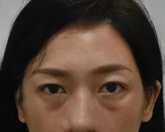 去眼袋手术