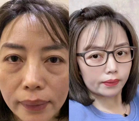 去眼袋手术