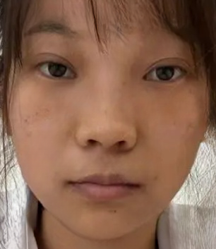 去眼袋手术