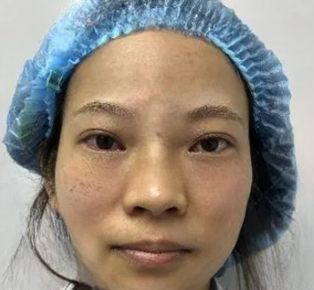 去眼袋手术