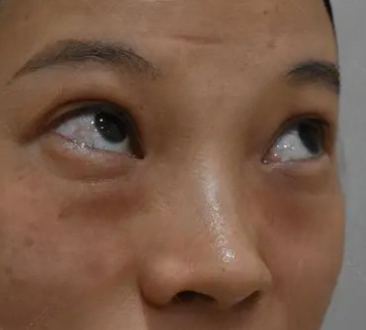 去眼袋手术