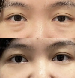 去眼袋手术