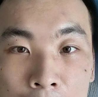 去眼袋手术