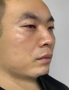 去眼袋手术