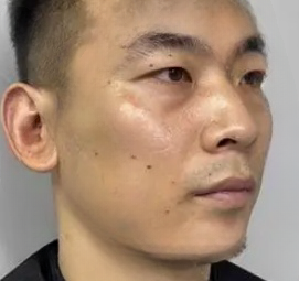去眼袋手术