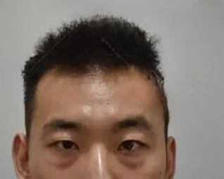 去眼袋手术