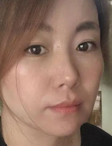 去眼袋手术