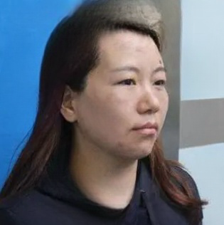 去眼袋手术