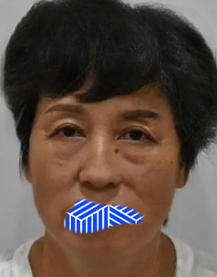去眼袋手术
