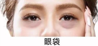去眼袋手术