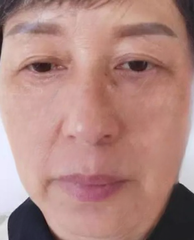 去眼袋手术