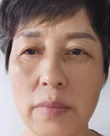 去眼袋手术