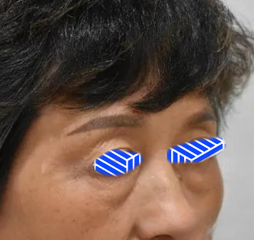 去眼袋手术
