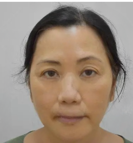 去眼袋手术